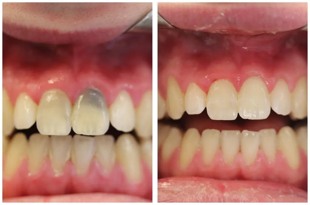 Patient receiving single tooth internal bleaching services